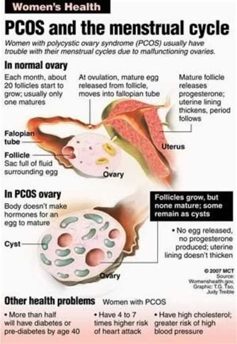 polycystic ovarian syndrome by dr prachi goel lybrate