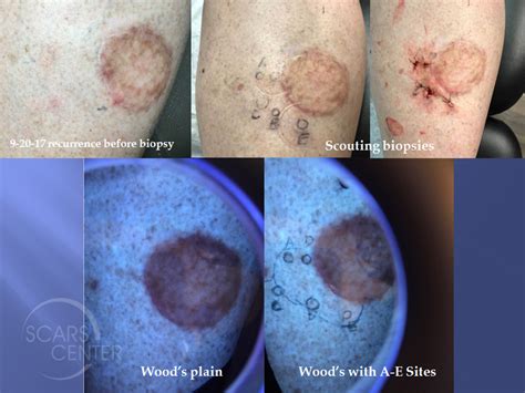 Mapping Of Recurrent Melanoma In Situ Of Leg Skin Cancer And