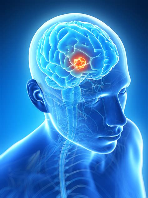 Use Of Neural Stem Cells For Treating Brain Tumors