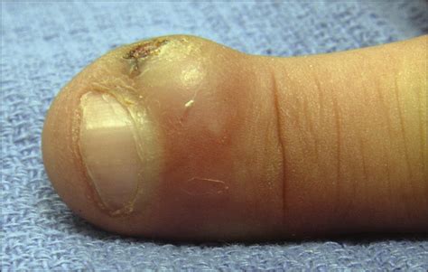Slowly Enlarging Nodule On A Finger—quiz Case Lifestyle Behaviors