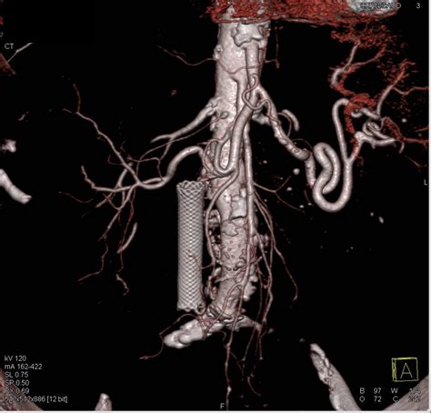 Wall Stent In The Common Bile Duct Liver Case Studies Ctisus Ct