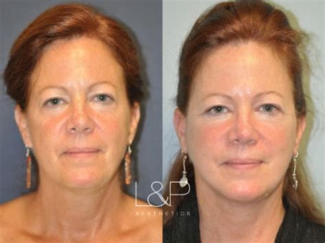 Facelift And Neck Lift Before And After Photos Case 31 Palo Alto And San