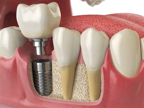 Holistic Tooth Replacement With Zirconia Dental Implants