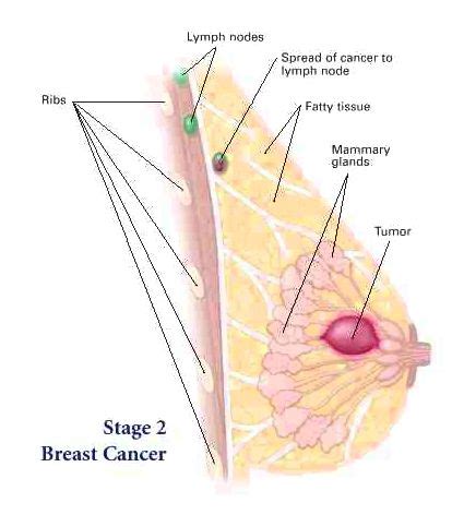 For example, survivors of childhood cancers can develop second cancers from some effects of treatment or because of hereditary or genetic problems. All that you should learn about stage 2 cancer of the ...