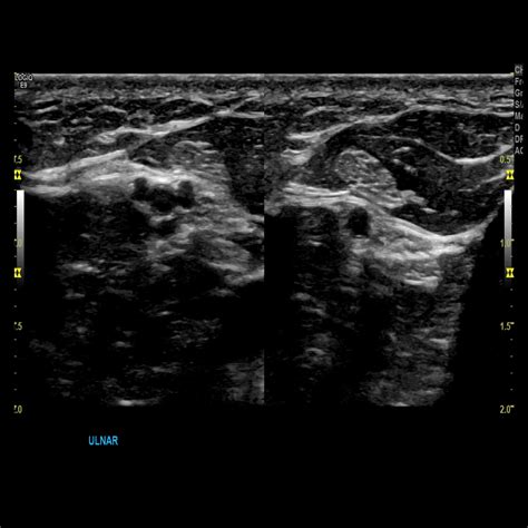Upper Extremity Venous Doppler Sonographic Tendencies Medical Ultrasound Vascular