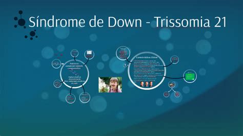 Síndrome De Down Trissomia 21 By Yonel Capita