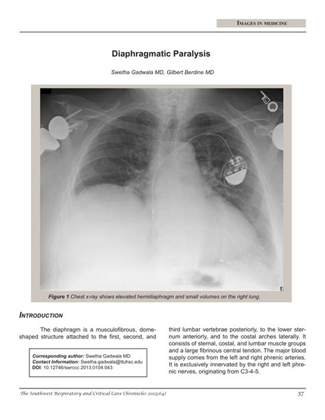 pdf diaphragmatic paralysis