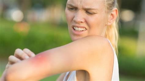 How To Identify And Treat Common Bug Bites Forbes Health