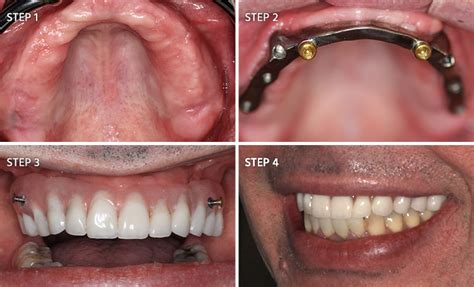 Full Mouth Reconstruction Before And After Photos Dr Chang