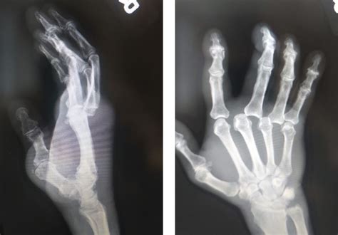 An Unusual Case Of Third And Fourth Metacarpophalangeal Joint