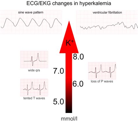 Hyperkalemia Ecg Findings Garetbetter