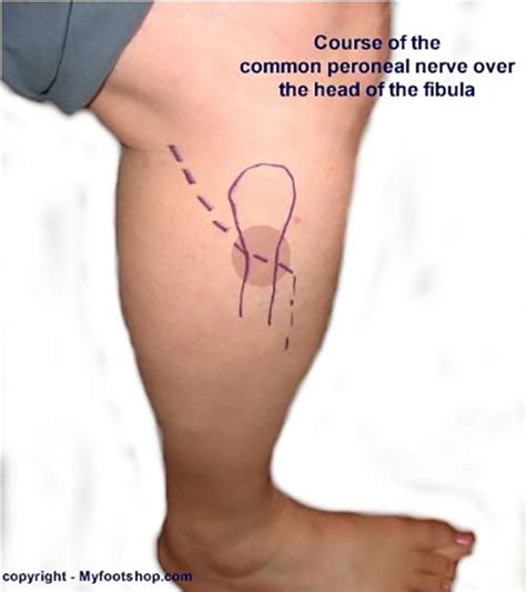 Common Peroneal Nerve Sensory
