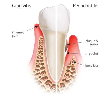 What Is Periodontitis Leading Dental Clinic In Dubai Best Dentist Near Me In Dubai Solis
