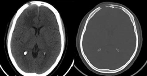 A Skull Ct Axial Cut Shows A Lytic Lesion In The Right Frontal Region
