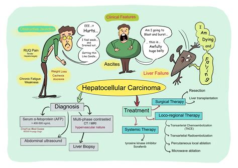 Hepatocellular Carcinoma Hcc Creative Med Doses