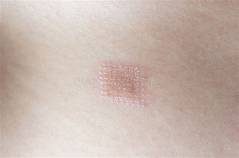 Marks After Laser Hair Or Scar Removal From The Skin Co2 Technique