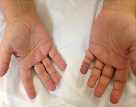 acute blue finger a diagnostic challenge bmj case reports