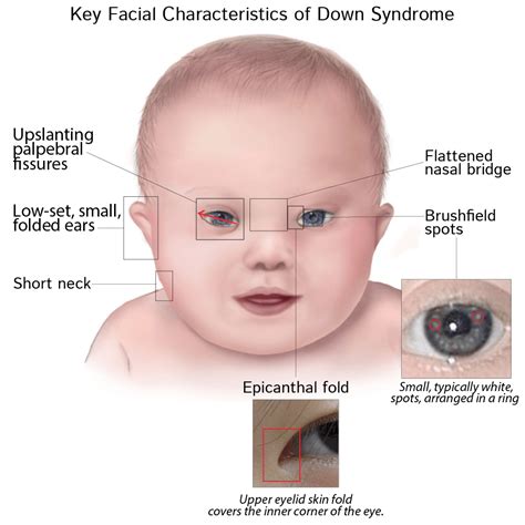 The Association Of Congenital Heart Defects Down Syndrome Blog