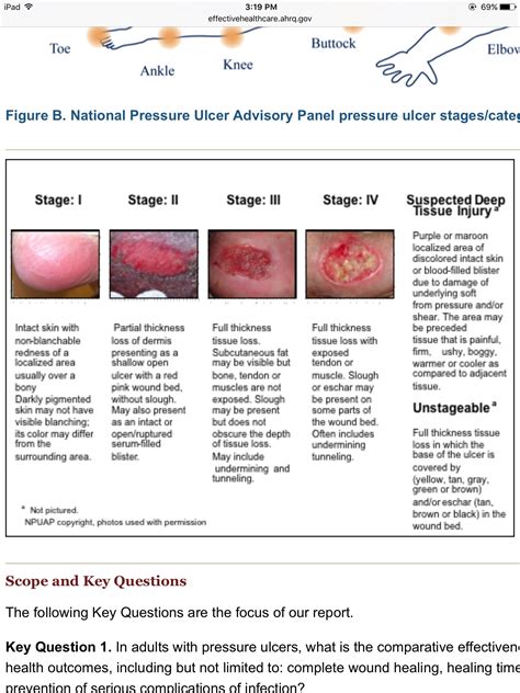 Pressure Ulcer Staging Chart Stages Of Pressure Injuries Pressure Ulcer