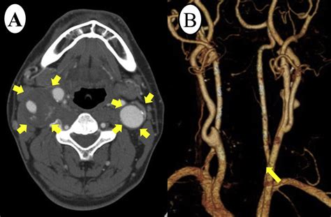 Bilateral Extracranial Carotid Artery Aneurysms Treated By Staged