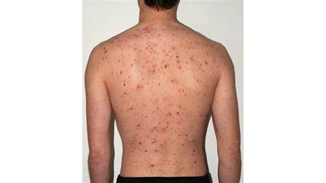 Rash On Back Causes Treatments Symptoms And More