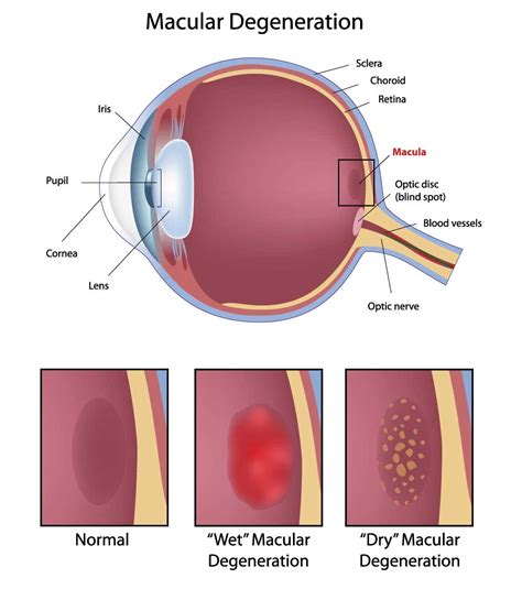 Makuladegeneration Augenarzt