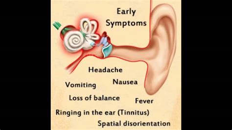 Inner Ear Infection Symptoms Youtube