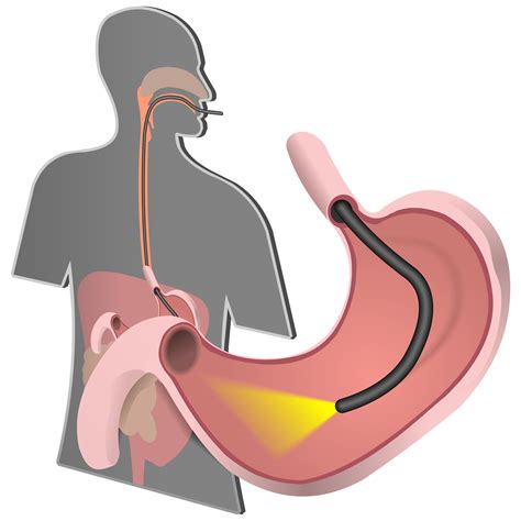Ercp Information