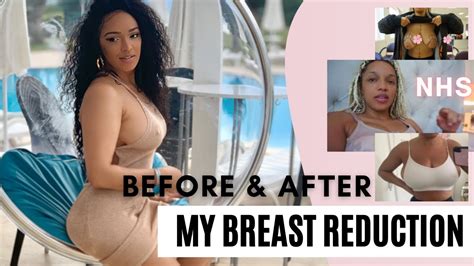 Full Surgery Day Vlog Breast Reduction Youtube