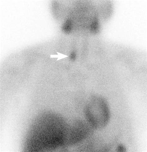 Figure 4 From Recurrent Hyperparathyroidism Due To Parathyroid And