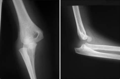 Pure Elbow Dislocation In The Paediatric Age Group Springerlink