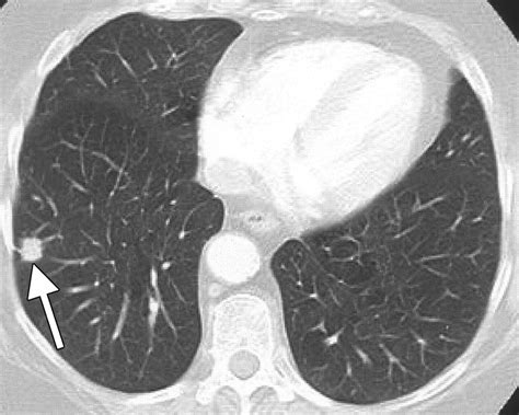 My 2 Cents Annual Lung Ct Scans For Smokers Good Or Bad Free Nude