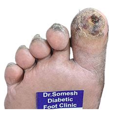 Diabetic Foot Gangrene Stages Great Toe Tip Podiatry Doctor