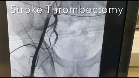 Stroke Thrombectomy Procedure Dr Gigy Kuruttukulam Stroke Rounds 22 Youtube