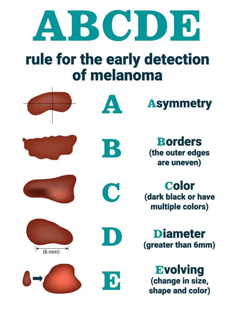 Melanoma Mole Vs Normal Mole