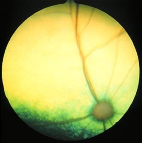 Learn more about the types, causes, risk factors, symptoms, diagnosis, treatment. Ophthalmology Conditions and Diseases Treated | Center For ...