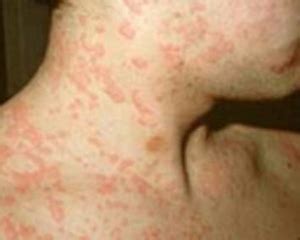 When symptoms of listeria infection are present, they usually consist of. Listeriosis