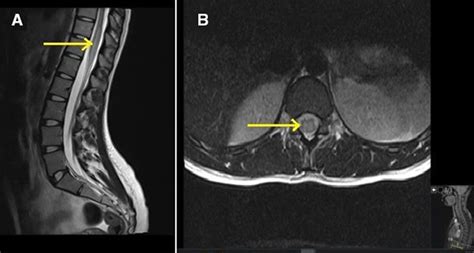 Conus Medullaris Syndrome As A Presenting Feature Of Mog Associated
