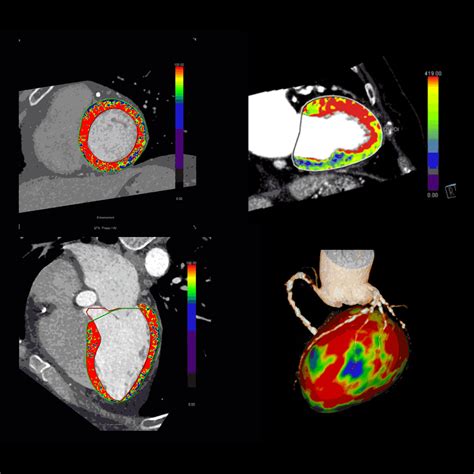 Ct Cardiovascular Imaging Siemens Healthineers