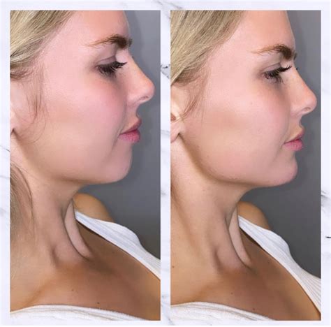 Chin And Jawline Fillers In Gilbert Az Colair Med Spa