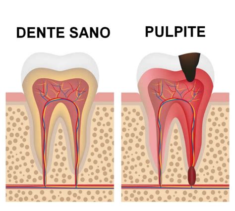 Pulpite Dentale Cos è Cause e Come Curarla Studio Biodental