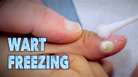 Freezing Warts With Sizzling Liquid Nitrogen Dr Paul Youtube