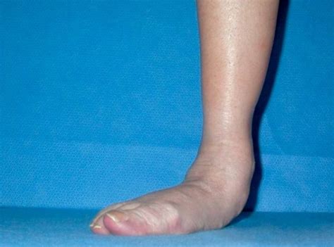 Flat Feet Treatment Augusta | Surgery | Shoes | Podiatrist ...