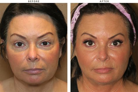 Mid Face Lift Before And After Pictures Dr Turowski Plastic