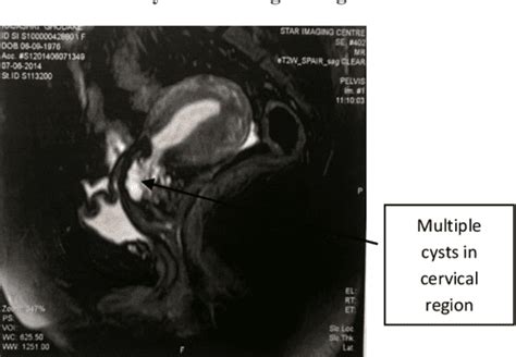 Figure 4 From An Unusual Presentation Of Nabothian Cyst A Case Report