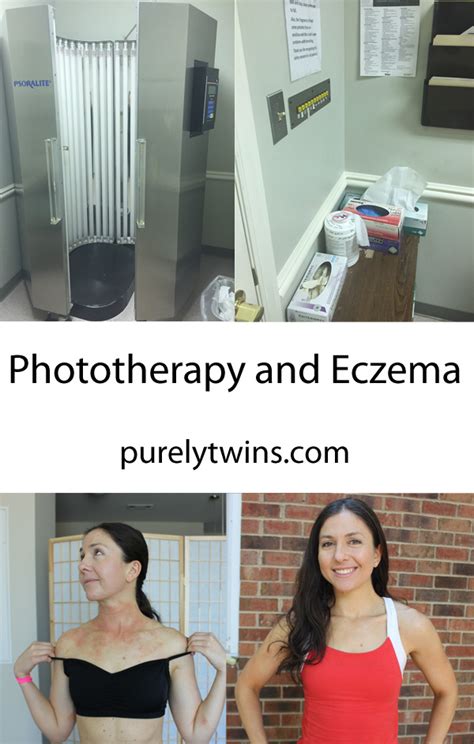 Phototherapy to treat eczema before and after pictures