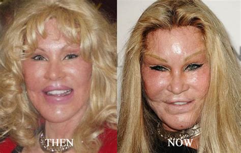 Jocelyn Wildenstein Plastic Surgery Before And After Face