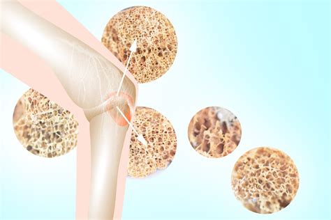 Osteoporosis síntomas y tratamiento ixalud es
