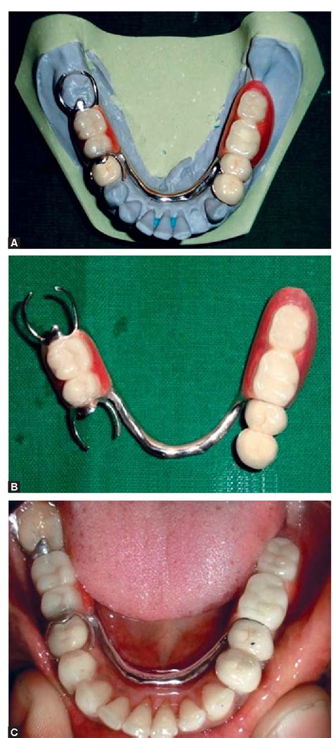 Unilateral Removable Partial Denture