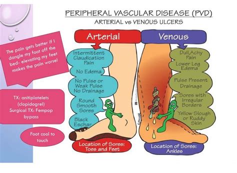 Venous and arterial ulcers are open wounds that commonly occur on your lower legs and feet. PVD - arteriole vs venous. Great review for a Med Surg ...